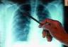 Tuberkuloza - dobro poznata, a još uvek opasna bolest