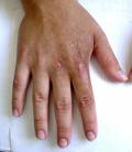 Phytophotodermatitis
