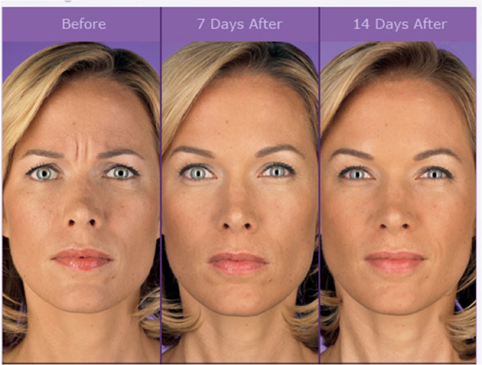 BOTOX - prva linija odbrane od starenja