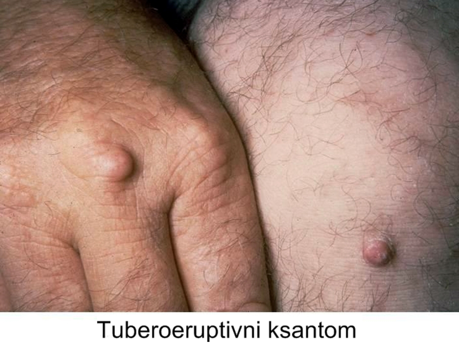 Porodična disbetalipoproteinemija