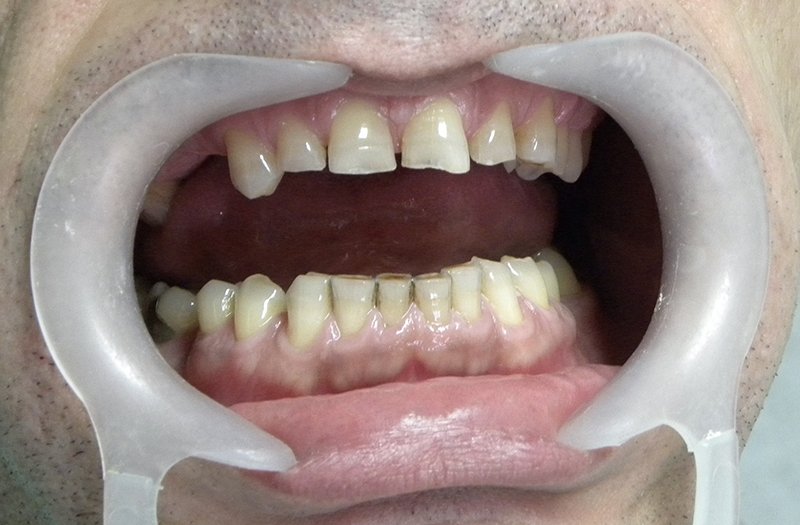 Bruksizam - Škripanje zubima