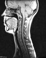 Neuromyelitis optica (Devicova bolest)