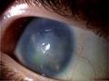 Aniridia