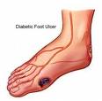 Dijabetesno stopalo