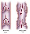 Flebotromboza (phlebothrombosis)