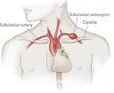 Aneurizme subklavijalne i aksilarne arterije