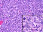 Rak prostate (Karcinom prostate)