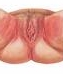 Ulcus vulvae acutum
