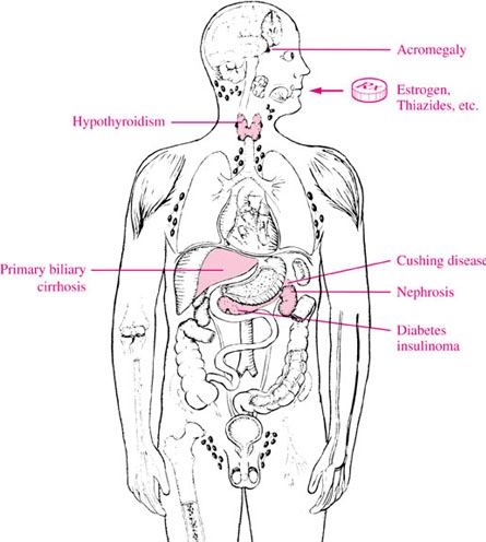 Porodična Hiperlipoproteinemija