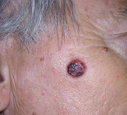 Maligni tumori kože