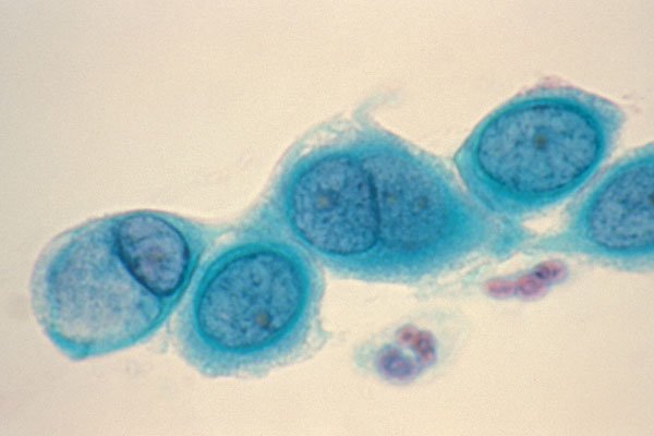 Hlamidija trahomatis (Chlamydia trachomatis) u genitourinarnom aspektu
