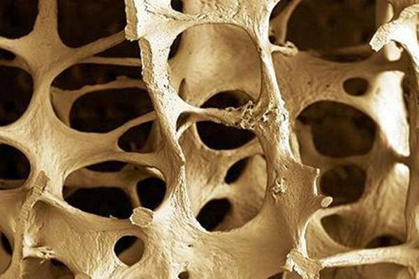 Osteoporoza - prevencija, dijagnostika i lečenje