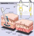 Liposukcija i dermolipektomija