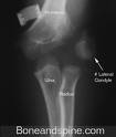 Prelomi kondila humerusa (Fractura condyli humeri lateralis/medialis)