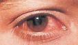 Konjuktivitis (Conjuctivitis)