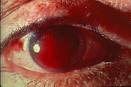 Hifema (Hyphema)