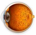 Retinitis pigmentosa