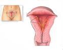 Akutni endometritis