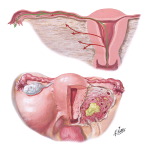 Parametritis