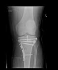 Prelomi kondila tibije (Fractura condily tibiae)