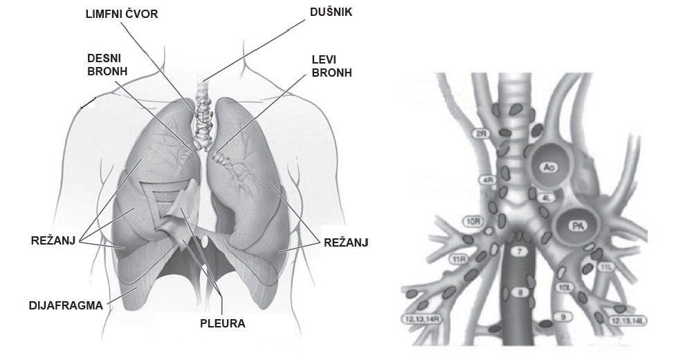 Radioterapija tumora pluća