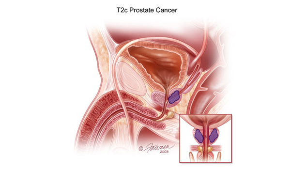 Odstranimo adenom prostate