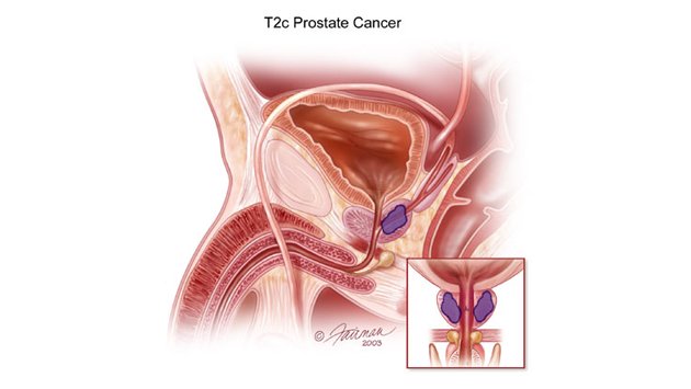 Debljina doprinosi progresiji karcinoma prostate