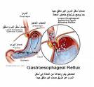 Gorušica (gastroezofagealni refluks)