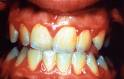 Gingivitis - upala desni