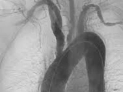 Takajašu bolest predstavlja upalni proces koji zahvata zidove aorte i njenih grana, nepoznate etiologij. Češće se javlja kod osoba ženskog pola, starosti od 15 do 30 godina.