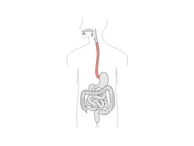 Barretov sindrom je stečeni defekt sluznice jednjaka u toku dužeg prisustva gastroezofagealnog refluksa (vraćanje sadržaja iz želuca i jednjaka) i najčešće je ispoljen u vidu ulceracija (grizlica) ili striktura (suženja), pretežno lokalizovan u distalnom delu jednjaka.