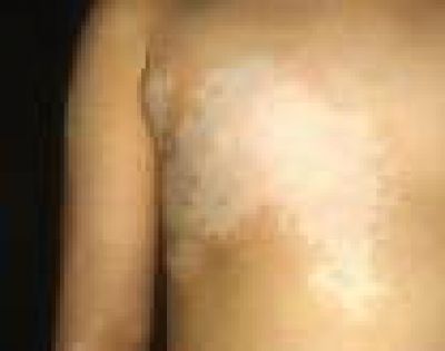 Vitiligo