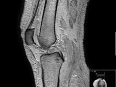 Gonartroza predstavlja artrozu kolenog zgloba. Artroza je degenerativna promena zglobne hrskavice, koja zatim uzrokuje promene i na ostalim delovima zgloba (zglobna čaura, kost), a pre ili posle se karakteriše bolom i oštećenom funkcijom zgloba.