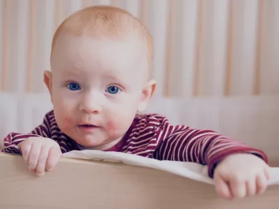 Najčešće se javlja već u prvim mesecima života, kao suva, osetljiva koža koja crveni i svrbi.