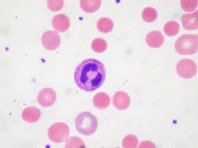 Hemolizne anemije nastaju zbog povećane destrukcije eritrocita u cirkulaciji. Povećanom razgradnjom eritrocita oslobađa se hemoglobin, a ovaj se dalje metaboliše do bilirubina.