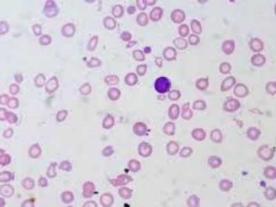 Fanconijeva anemija je oblik urođene aplastične anemije. Aplastična anemija je naziv za bolest kod koje je koštana srž vrlo slabo razvijena, a posledica toga je manjak svih krvnih ćelija u cirkulaciji.