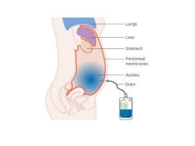 Ascites predstavlja nakupljenu tečnost u slobodnoj trbušnoj duplji i javlja se kod mnogih oboljenja i poremećaja u trbušnoj duplji.
