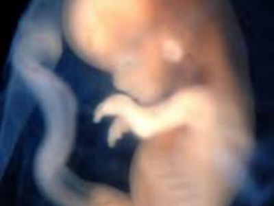 Preeklampsija Preeklampsija i eklampsija su komplikacije trudnoće. Kod preeklampsije postoji veoma opasno povišenje krvnog pritiska, oticanje nogu i ruku, i izlučivanje belančevina putem mokraće.