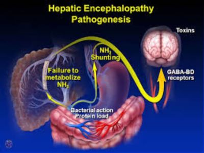 Hepatična encefalopatija predstavlja oboljenje mozga koje nastaje usled akutne ili hronične hepatičke (jetrene) insuficijencije. Može biti endogena i egzogena.