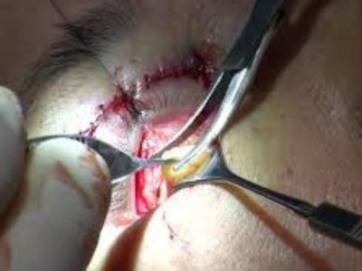 Ptoza (Ptosis, Blepharoptosis) Ptoza (ptosis) je spuštenost gornjeg kapka, jer je aktivno podizanje kapka u većoj ili manjoj meri oslabljeno. Nastaje zbog slabe funkcije podizača kapka (m. levator palpebrae superior).