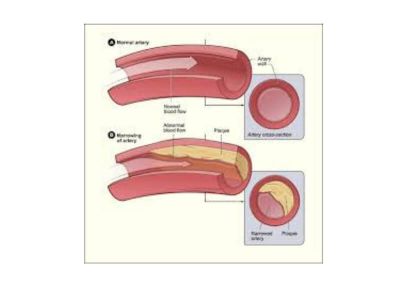 Obliterantna arterioskleroza je najčešća bolest perifernog arterijskog sistema. U novoj nomenkalturi Svetske zdravstvene organizacije ovoj bolesti dat je naziv periferna vaskularna bolest, a po najznačajnijem simptomu ove bolesti naziva se i intermitentna klaudikacija.