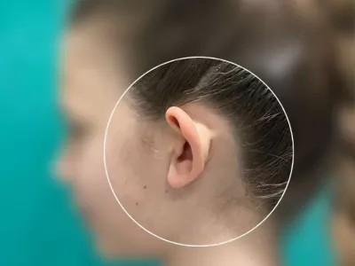 Operacija ušiju kod dece: Sveobuhvatan vodič za roditelje Primarni razlog za otoplastiku kod dece su istaknute, ili „klempave“ uši, stanje koje je najčešće nasledno.