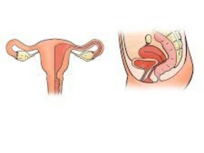 Delimično ili potpuno ispadanje materice spada u najveće spoljašnje poremećaje statike genitalnih organa.