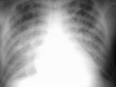 Akutni edem pluća je hitno dramatično stanje koje zahteva neodložnu i adekvatnu intervenciju, a karakteriše ga po život opasno nakupljanje tečnosti u plućima tj. u plućnim alveolama (zbog povišenog plućnog kapilarnog pritiska ili poremećene propustljivosti kapilarno - alveolarne membrane pluća).