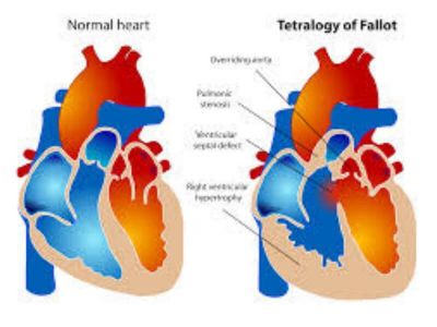 Tetralogija Fallot je najčešća cijanozna urođena srčana mana i predstavlja 10% svih urođenih anomalija.