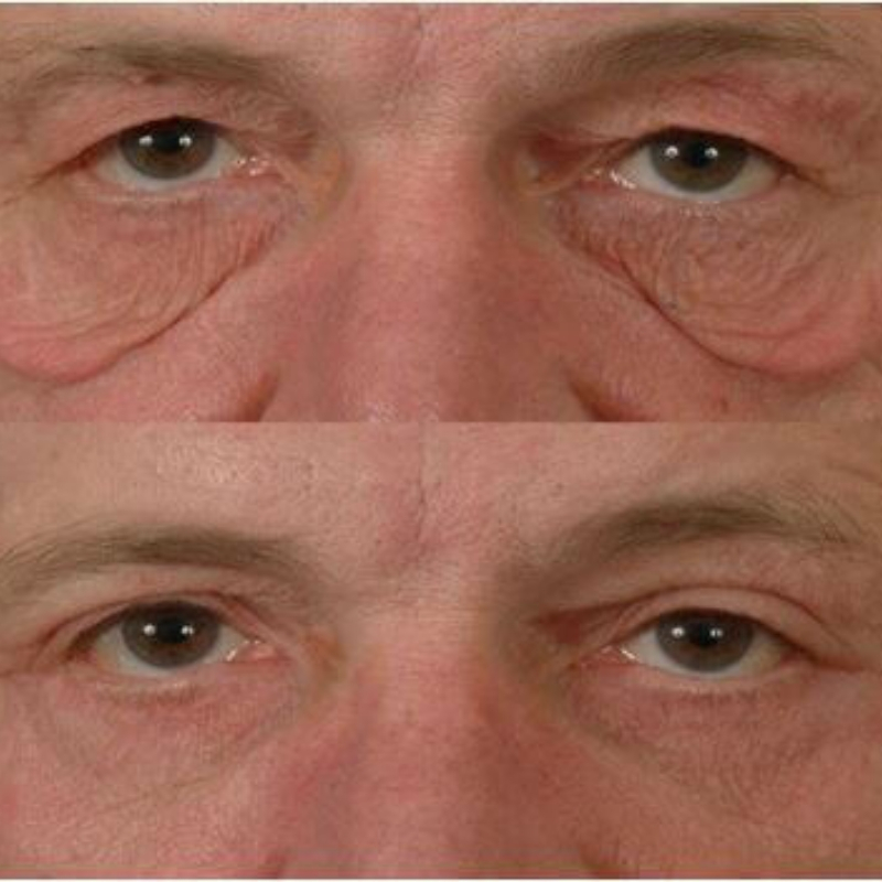 Blefaroplastika (podizanje očnih kapaka) Podizanje očnih kapaka pre i posle