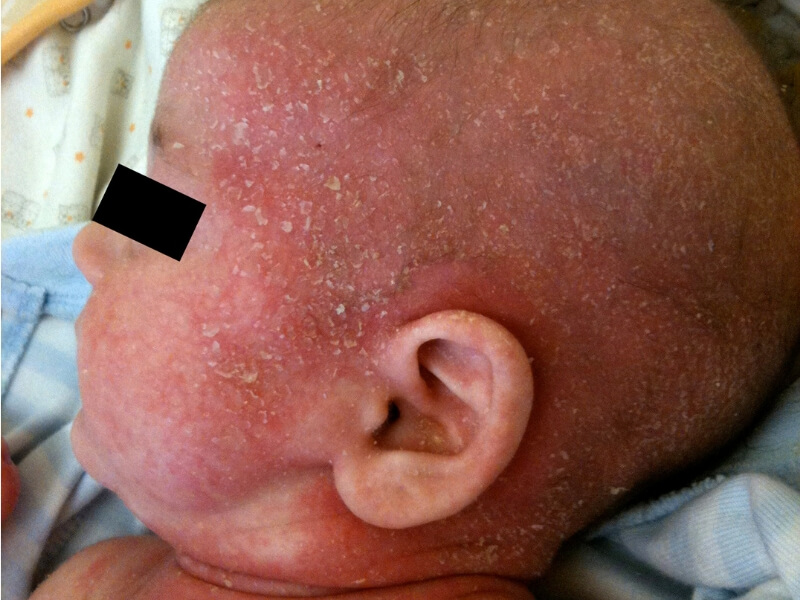 Atopijski dermatitis (Ekcem)