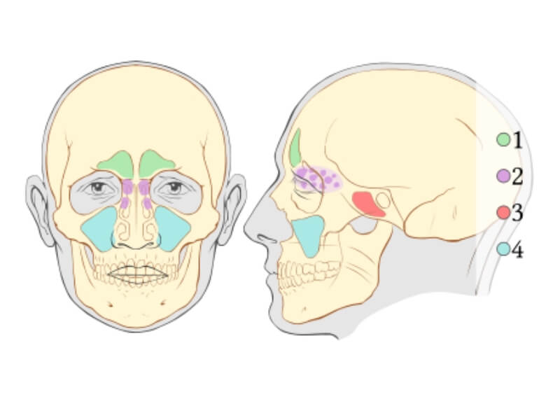 Upala sinusa (sinusitis ili rinosinuzitis)