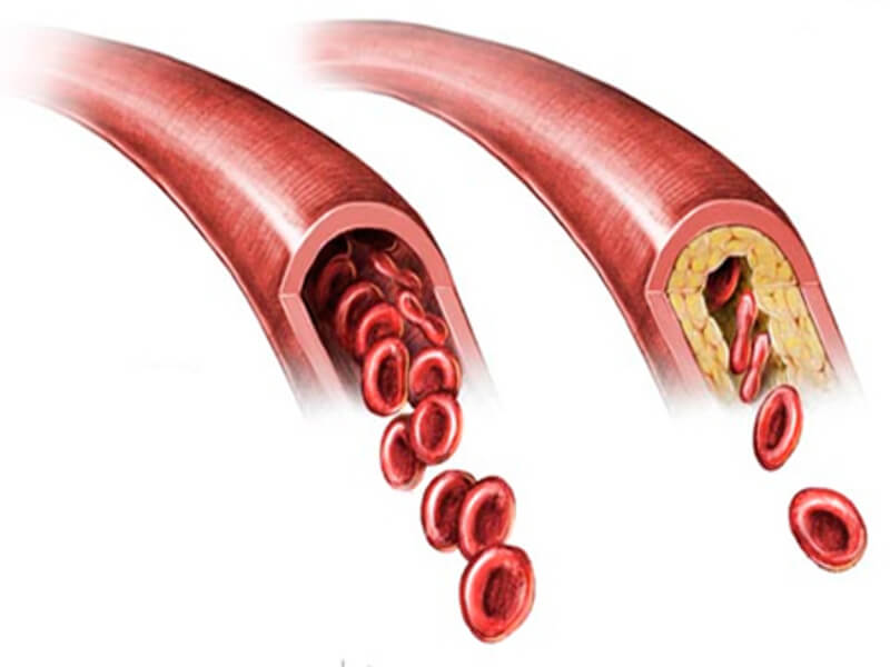 Ateroskleroza (suženje arterija)