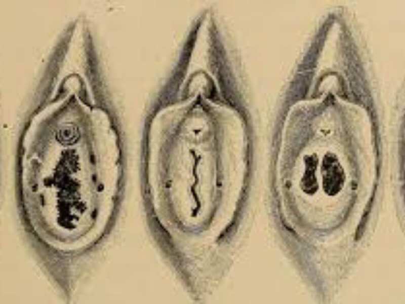 Hymen imperforatus